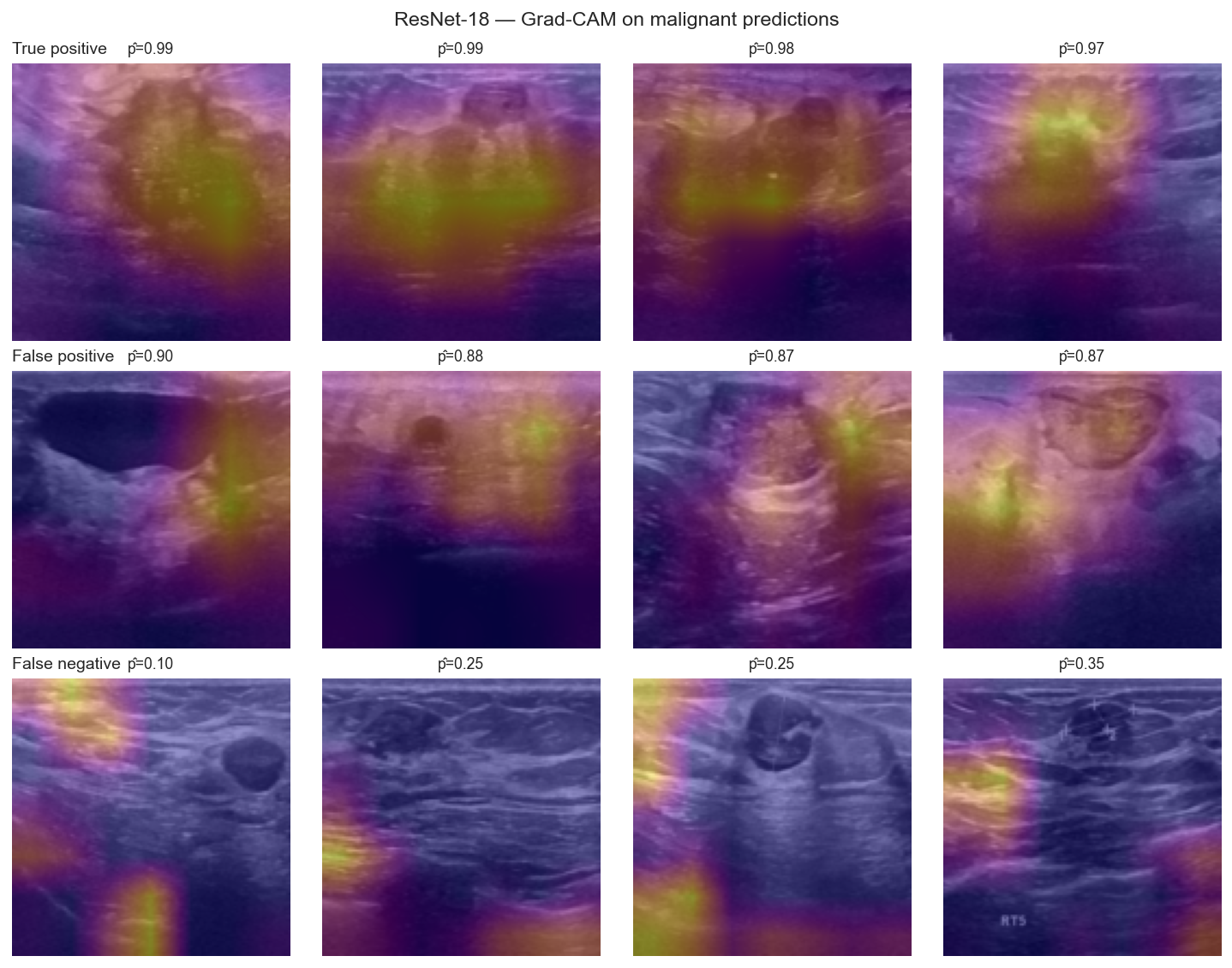 ResNet-18 Grad-CAM case grid
